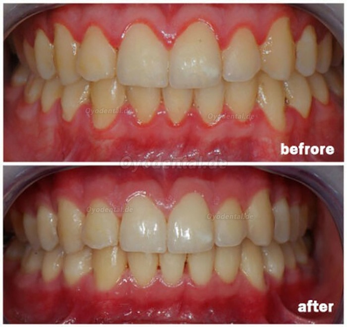 Zahnarzt-Diodenlaser Kabellos Parodontal Weichteillaser Dioden-Laser Zahnmedizin