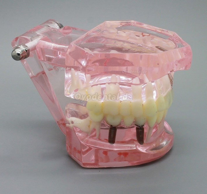 Zahnimplantatstudie Analyse Demonstration Zahnmodell mit Restauration 2001 Rosa
