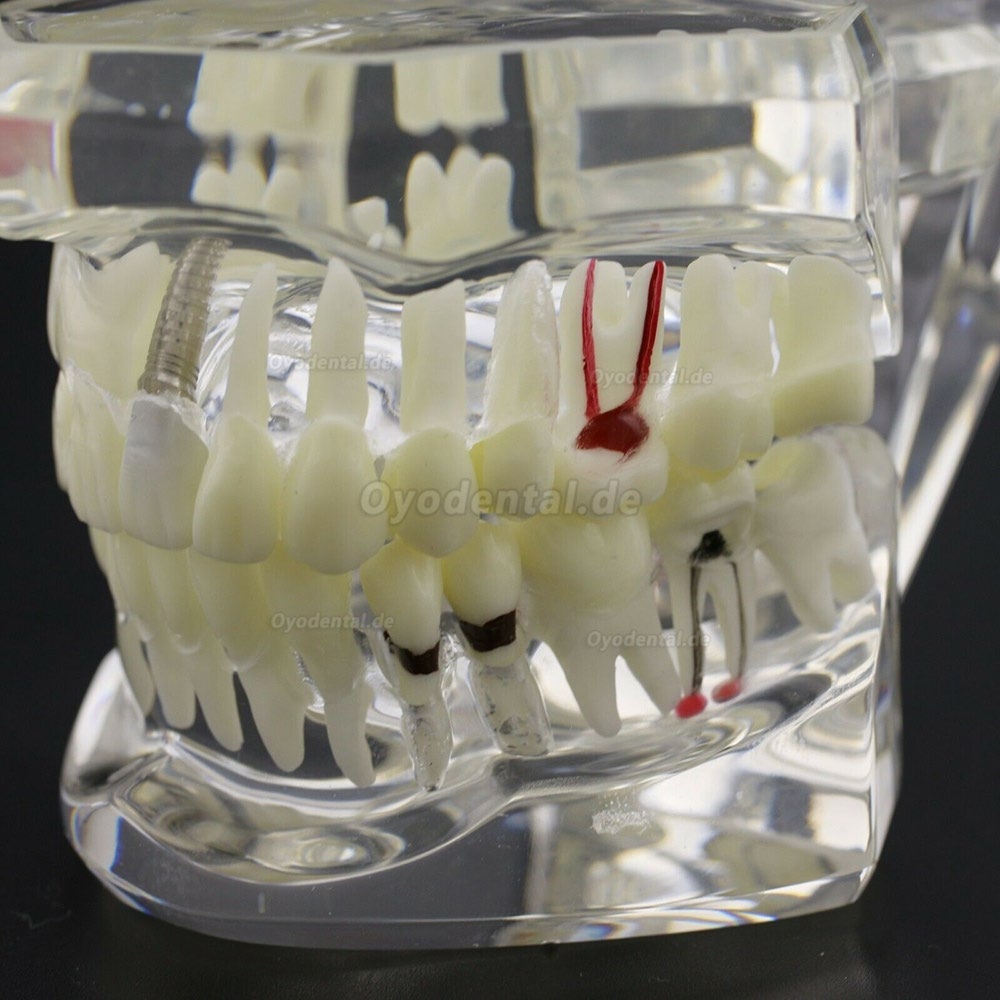 Modell der Zahnkrankheit Implant Demo Karies Parodont Transparent Rosa