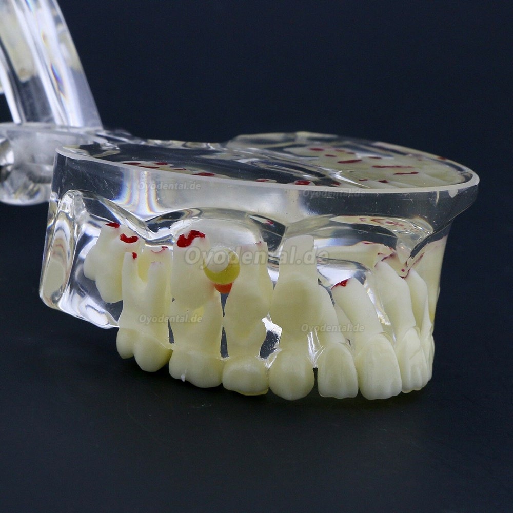 Neue Zahnheilkunde Kinder Pädiatrische Pathologie Demonstrationsstudie Zähne Modell 4002