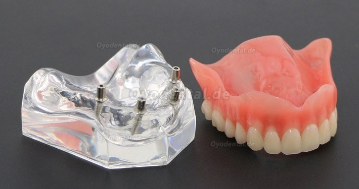 Anatomisches Modell der Zahnzähne Überprothese Superior mit 4 Implantaten Demo Modell 6001