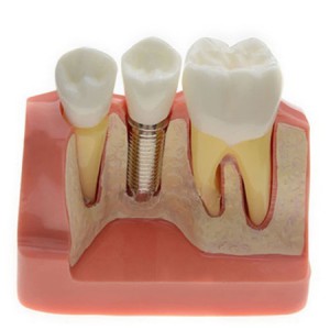 Analysemodell für Zahnimplantat M2017