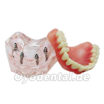 Dental Abnehmbare Overdenture Inferior mit 4 Implantaten Demo Zähne Studie Modell Dental Abnehmbare Overdenture Inferior mit 4 Implantaten Demo Zähne Studie Modell