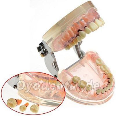 Dental Studie transparent Erwachsene pathologischen Parodontale Erkrankungen Zähne Modell 4017 Dental Studie transparent Erwachsene pathologischen Parodontale Erkrankungen Zähne Modell 4017