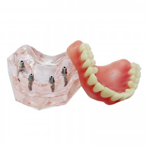 Dental Abnehmbare Overdenture Inferior mit 4 Implantaten Demo Zähne Studie Modell