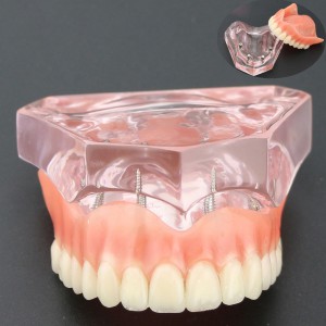 Dental Implantat rrepair Overdenture Oral Modell 6001