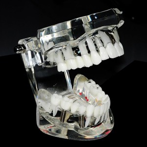 Zahnimplantatstudie Analysedemonstration Zähne Krankheiten Modell Restoration