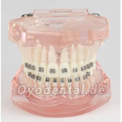 Dental Kieferorthopädie Behandlung Modell Demo Zähne MetallbracketsModel M3001