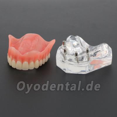 Anatomisches Modell der Zahnzähne Überprothese Superior mit 4 Implantaten Demo Modell 6001