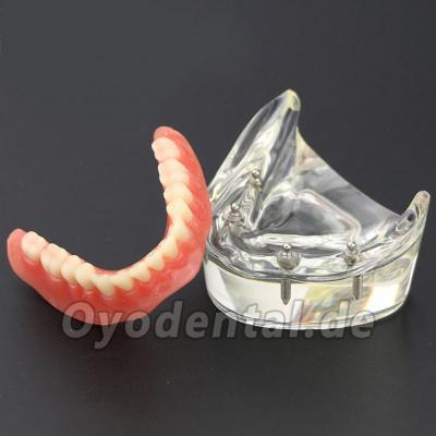 Dental Lower Zähne Demo-Studienmodell 6002 02 Overdenture Unten 4 Implantate