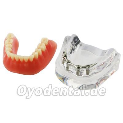 Dental Minderwertige Zähne Modell Overdenture Precision 4 Implantate Demo Silver Bar