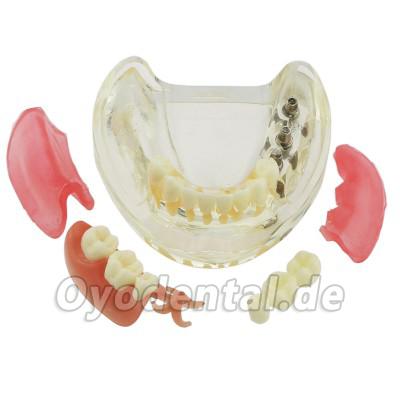 Dental Zähne Modell minderwertig abnehmbare Restauration Implantatbrücke Demo Modell 6006