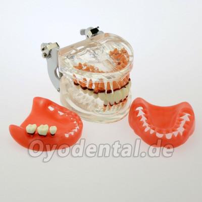Dentalmodell Erwachsene Pathologische Parodontitis Studienzähne Modell 4017
