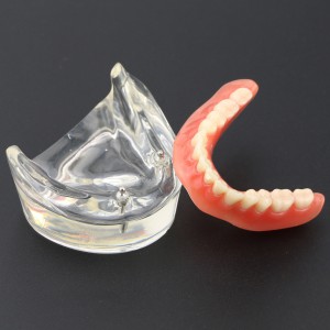 Modell für zahnärztliche Oberzähne Overdenture Superior 4 Implantate Demo Modell 6001 02