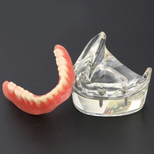 Dental Lower Zähne Demo-Studienmodell 6002 02 Overdenture Unten 4 Implantate