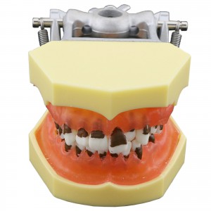 Das Modell der Parodontose zeigt entzündete Zahnfleischkalküle 4003