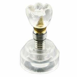 Modell der Zahnzähne Modell des Implantats Demonstrationsstudie Lehrmodell Demo 2020