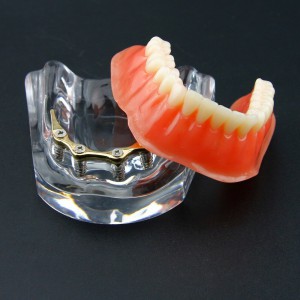 Dental Overdenture Typodont Modell Minderwertiges Präzisionsimplantat Golden 6009