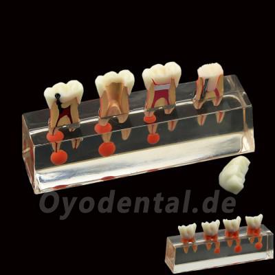 Zahnzahnmodell 4-stufige endodontische Behandlung zeigt anatomisches M4018-01