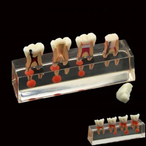 Zahnzahnmodell 4-stufige endodontische Behandlung zeigt anatomisches M4018-01