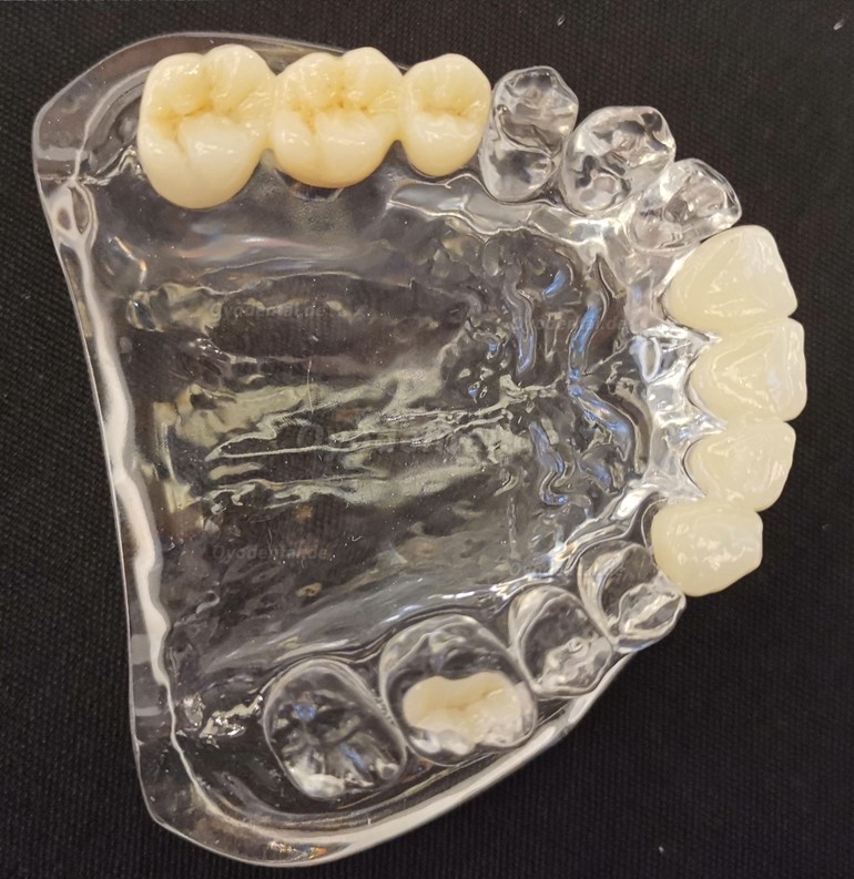 1 Stück 3D Dentallabor Mehrschichtiger Zirkon Ronden CAD/CAM-Keramikblock