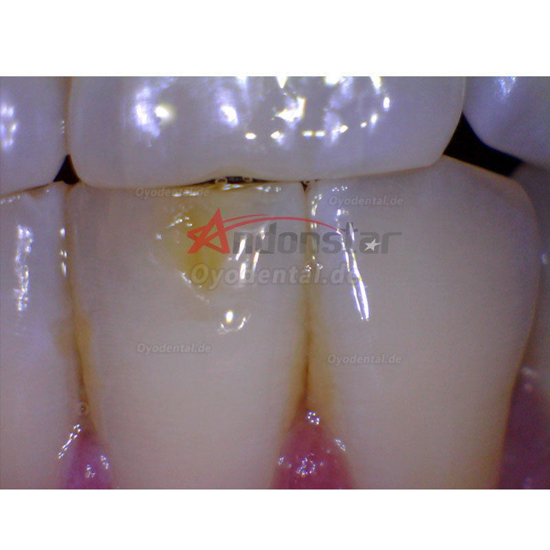 Dental Endoskop Lupe Oral HNO Kamera Vedio 2MP USB Digital Mikroskop