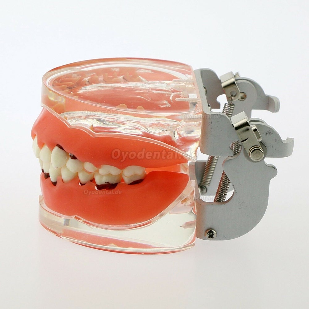 Dentalmodell Erwachsene Pathologische Parodontitis Studienzähne Modell 4017