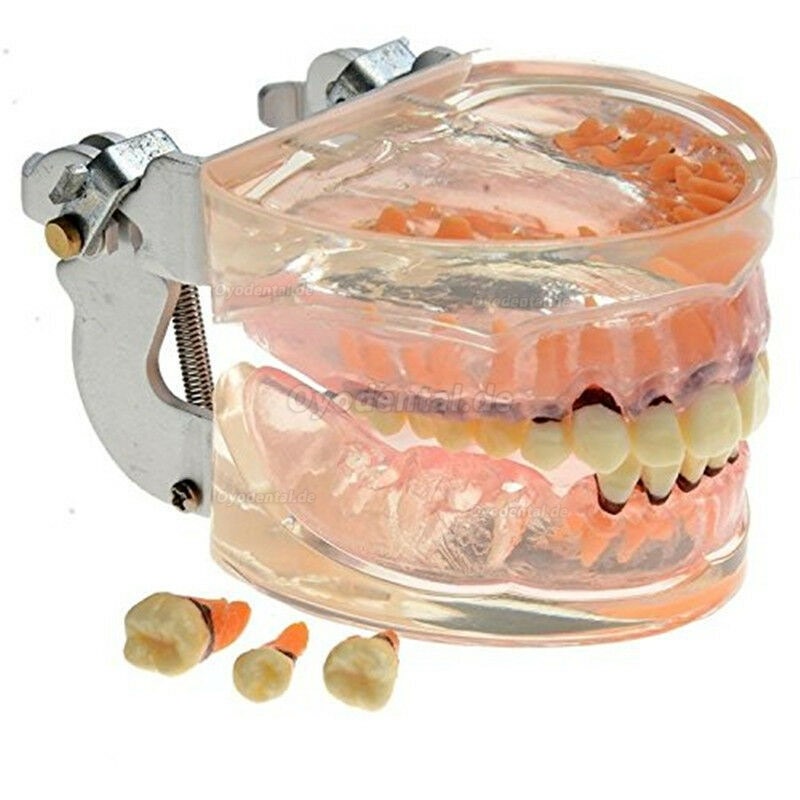 Dentalmodell Erwachsene Pathologische Parodontitis Studienzähne Modell 4017