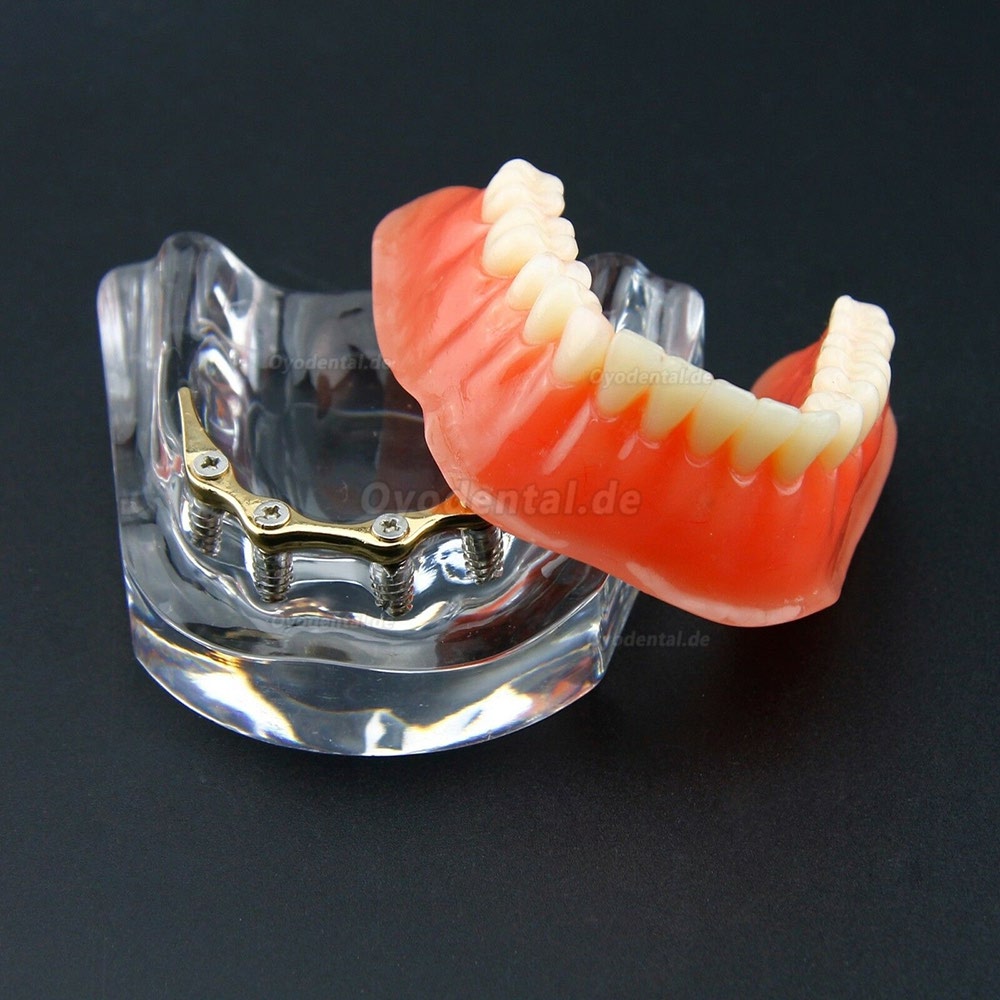 Dental Overdenture Typodont Modell Minderwertiges Präzisionsimplantat Golden 6009