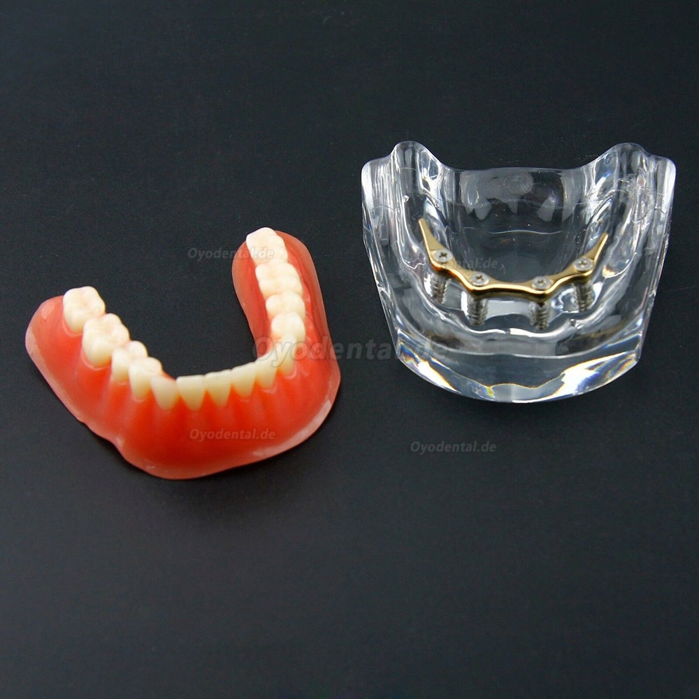 Dental Overdenture Typodont Modell Minderwertiges Präzisionsimplantat Golden 6009