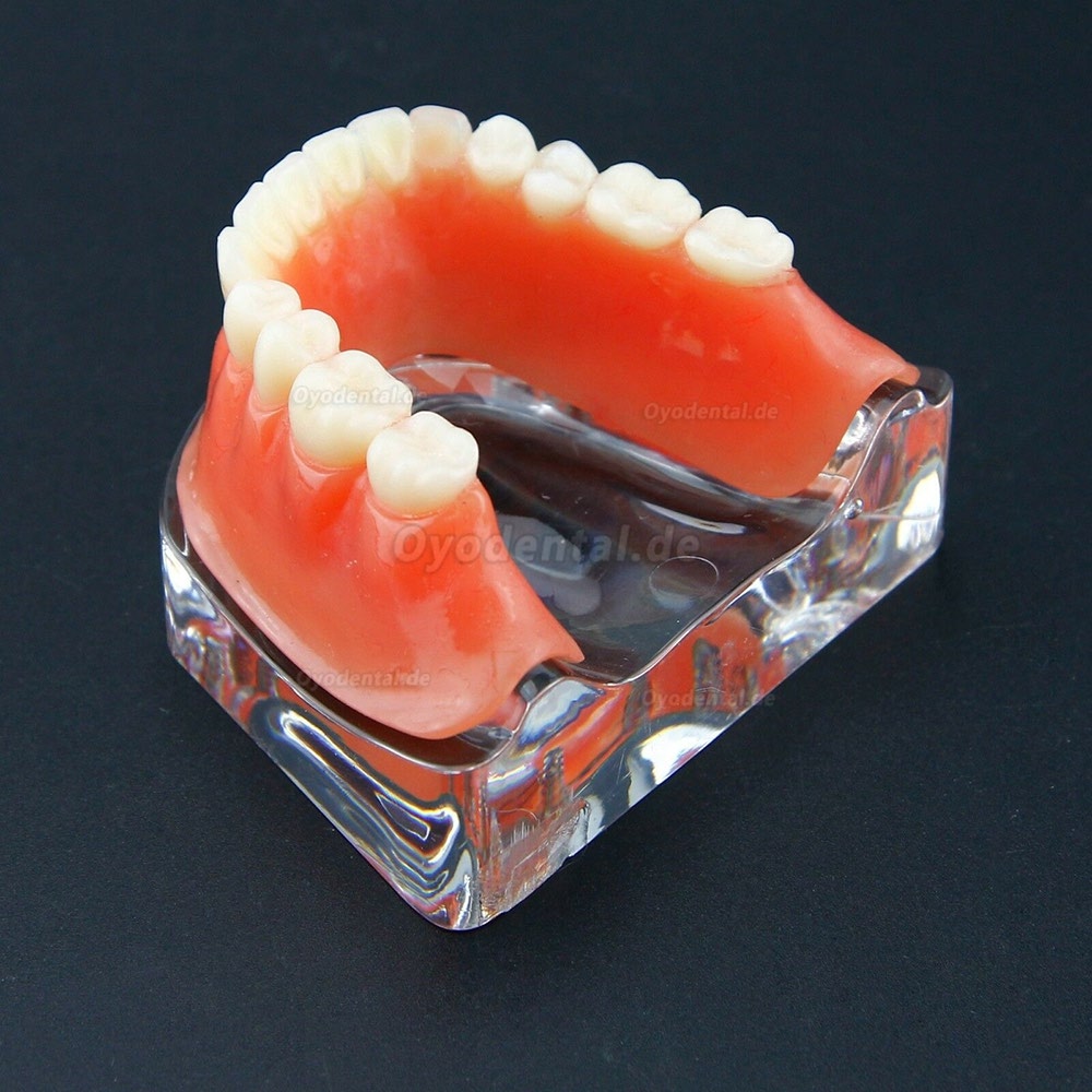 Dental Overdenture Typodont Modell Minderwertiges Präzisionsimplantat Golden 6009