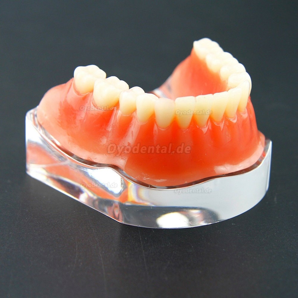 Dental Overdenture Typodont Modell Minderwertiges Präzisionsimplantat Golden 6009