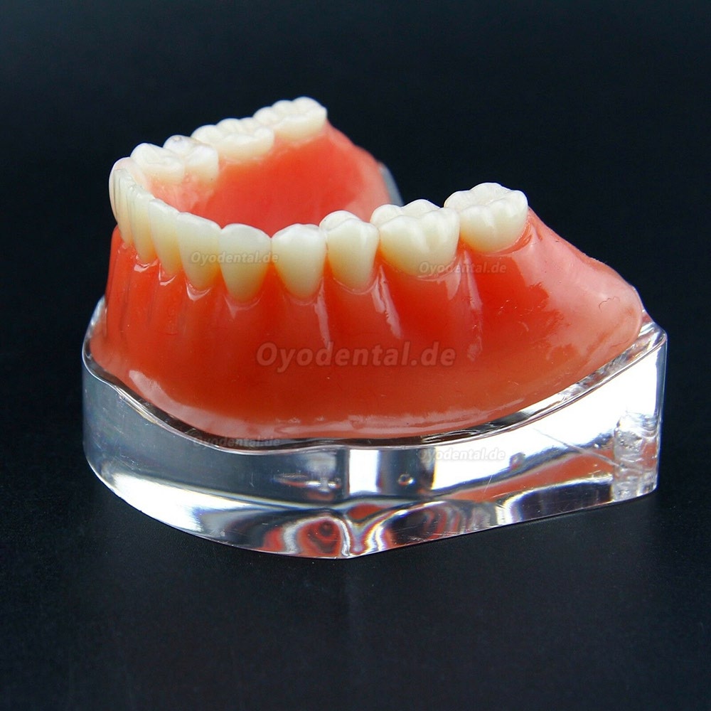 Dental Overdenture Typodont Modell Minderwertiges Präzisionsimplantat Golden 6009