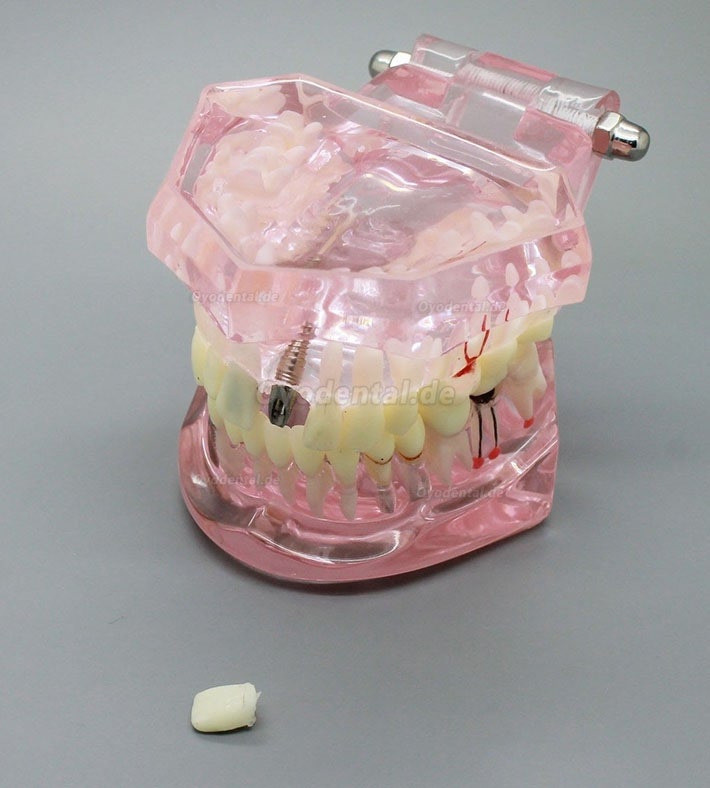 Zahnimplantatstudie Analyse Demonstration Zahnmodell mit Restauration 2001 Rosa
