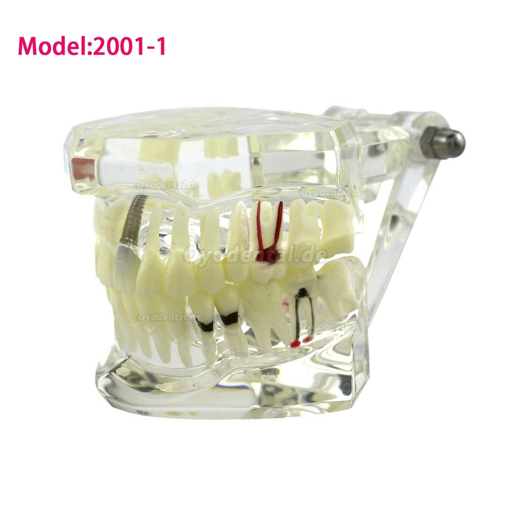 Modell der Zahnkrankheit Implant Demo Karies Parodont Transparent Rosa