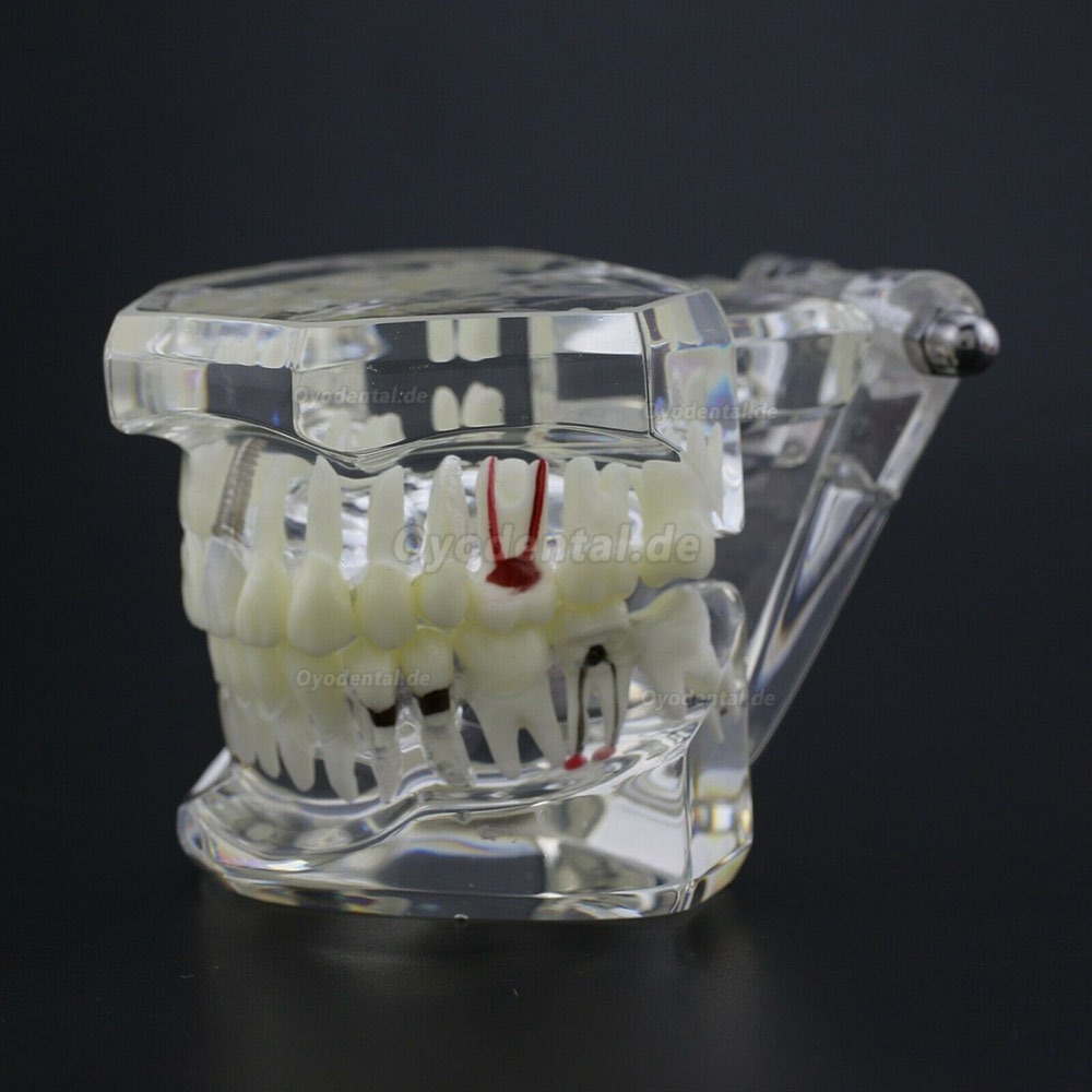 Modell der Zahnkrankheit Implant Demo Karies Parodont Transparent Rosa