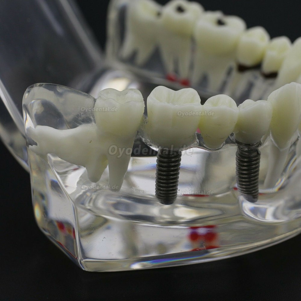 Modell der Zahnkrankheit Implant Demo Karies Parodont Transparent Rosa