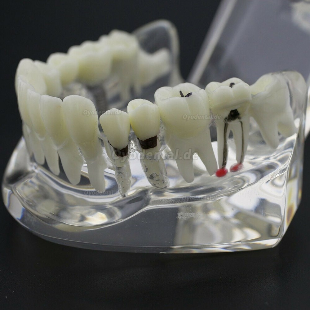 Modell der Zahnkrankheit Implant Demo Karies Parodont Transparent Rosa