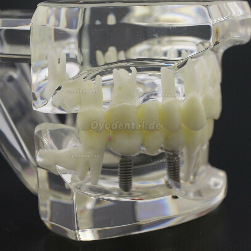 Modell der Zahnkrankheit Implant Demo Karies Parodont Transparent Rosa