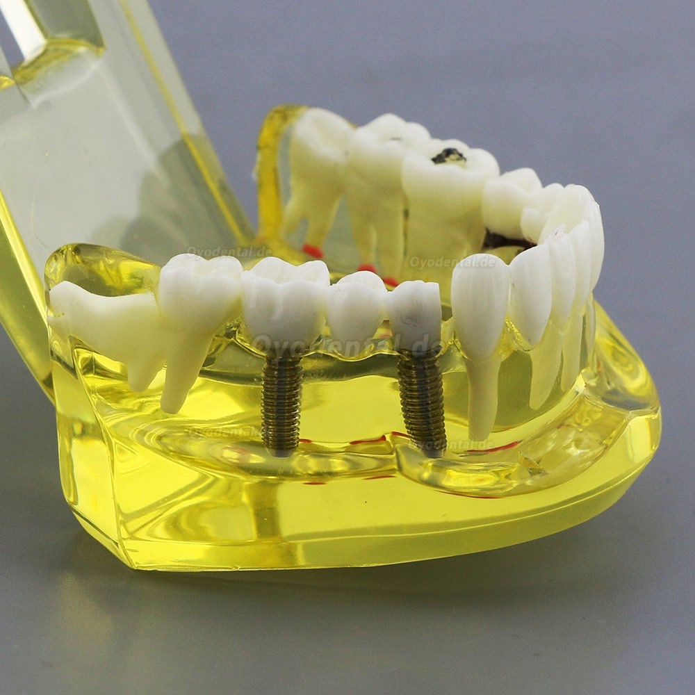 Modell der Zahnzähne Unterrichten Sie das Studium Oral Implantatversorgung & Pathologie 2001 Gelb