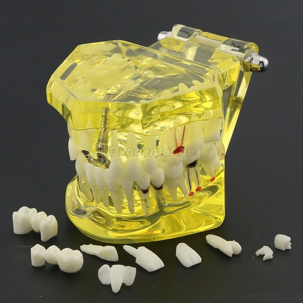 Modell der Zahnzähne Unterrichten Sie das Studium Oral Implantatversorgung & Pathologie 2001 Gelb