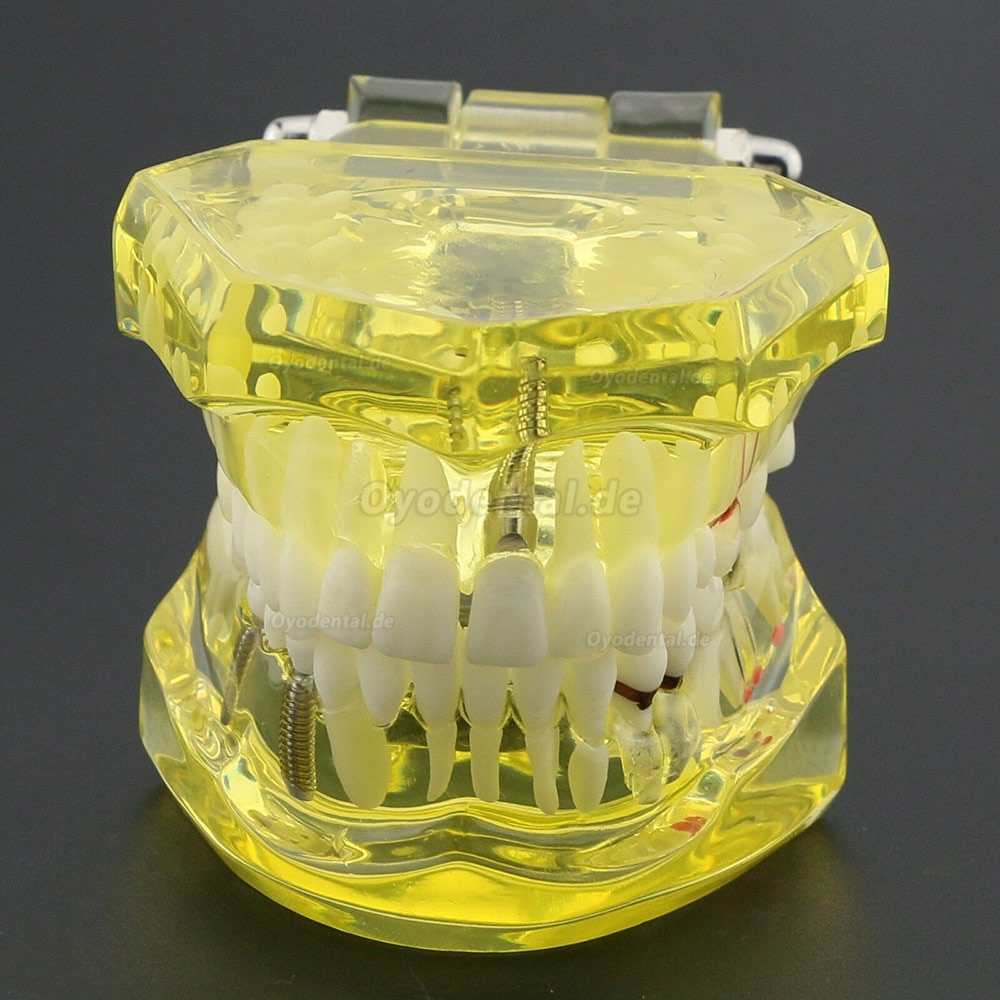 Modell der Zahnzähne Unterrichten Sie das Studium Oral Implantatversorgung & Pathologie 2001 Gelb