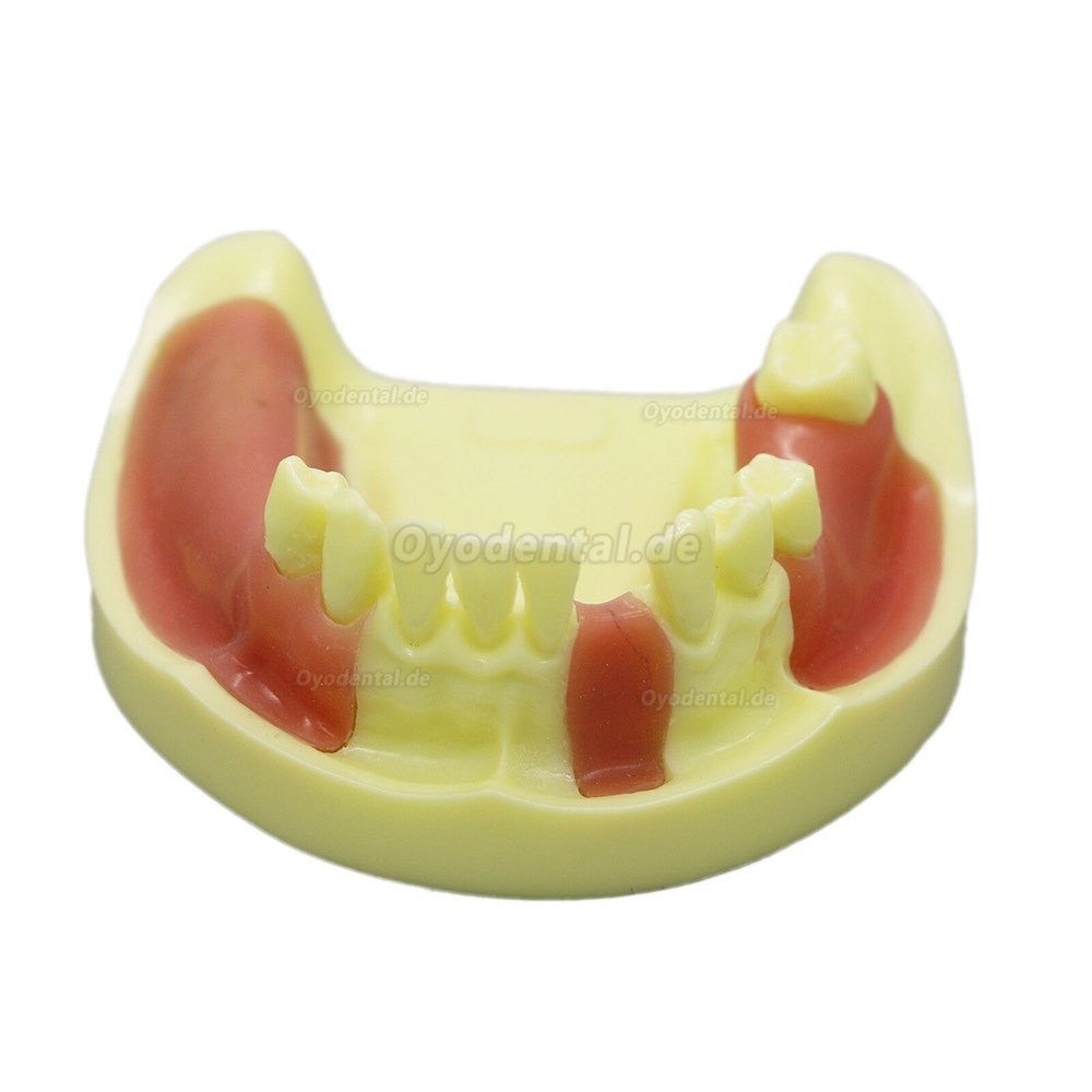 Dental Model # 2004 01 - Unterkieferimplantat-Übungsmodell mit Gingiva