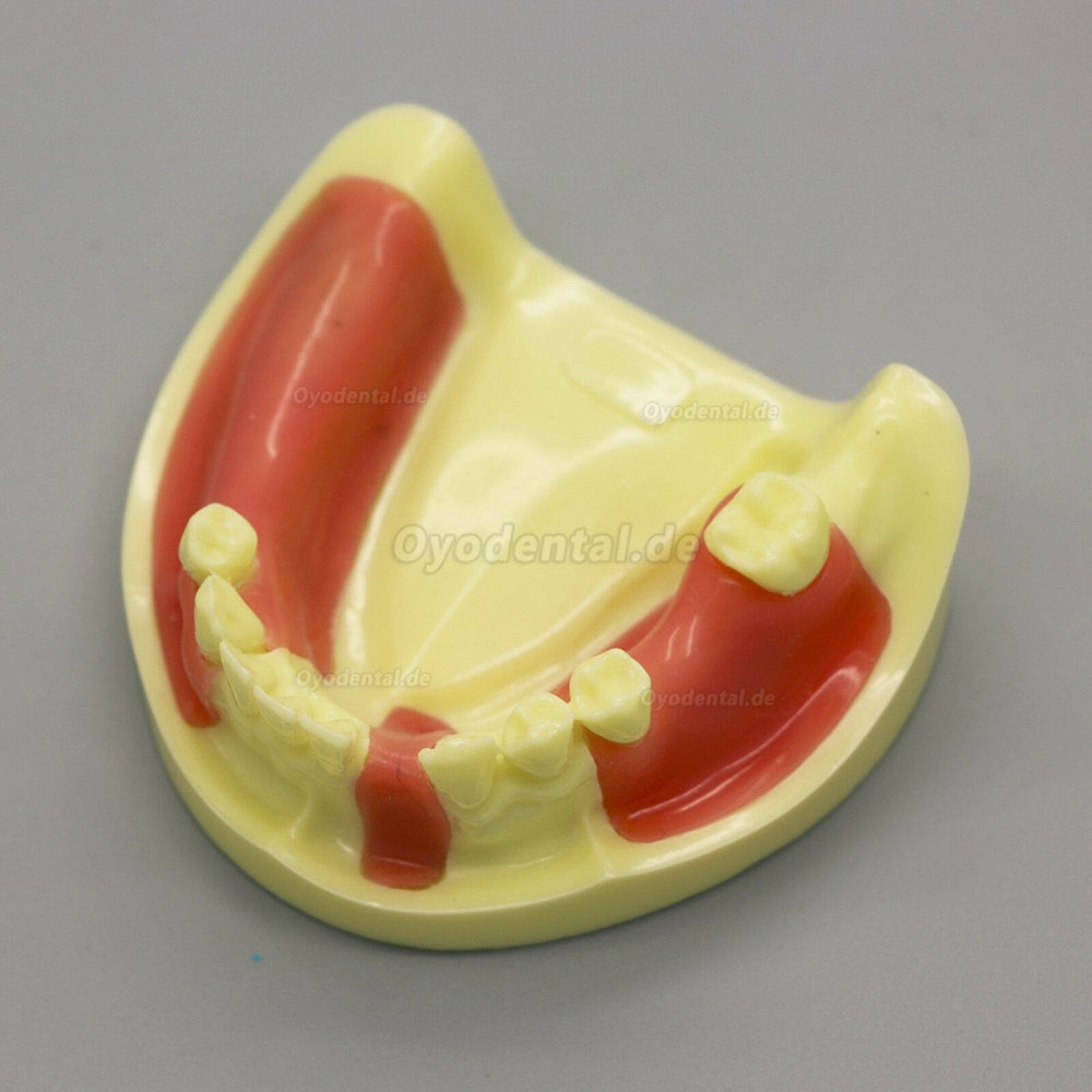 Dental Model # 2004 01 - Unterkieferimplantat-Übungsmodell mit Gingiva