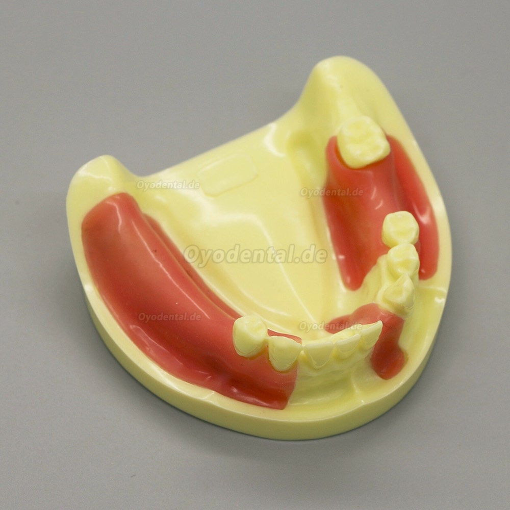 Dental Model # 2004 01 - Unterkieferimplantat-Übungsmodell mit Gingiva