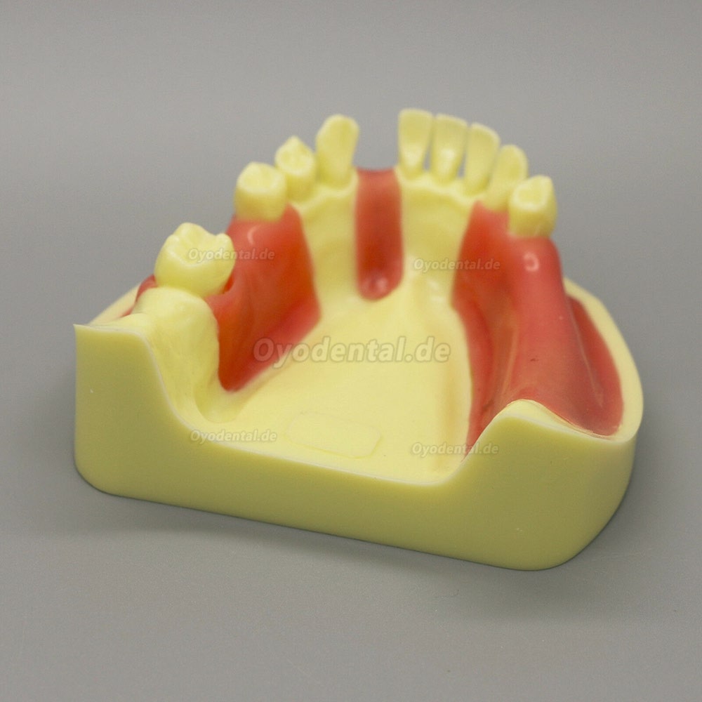 Dental Model # 2004 01 - Unterkieferimplantat-Übungsmodell mit Gingiva