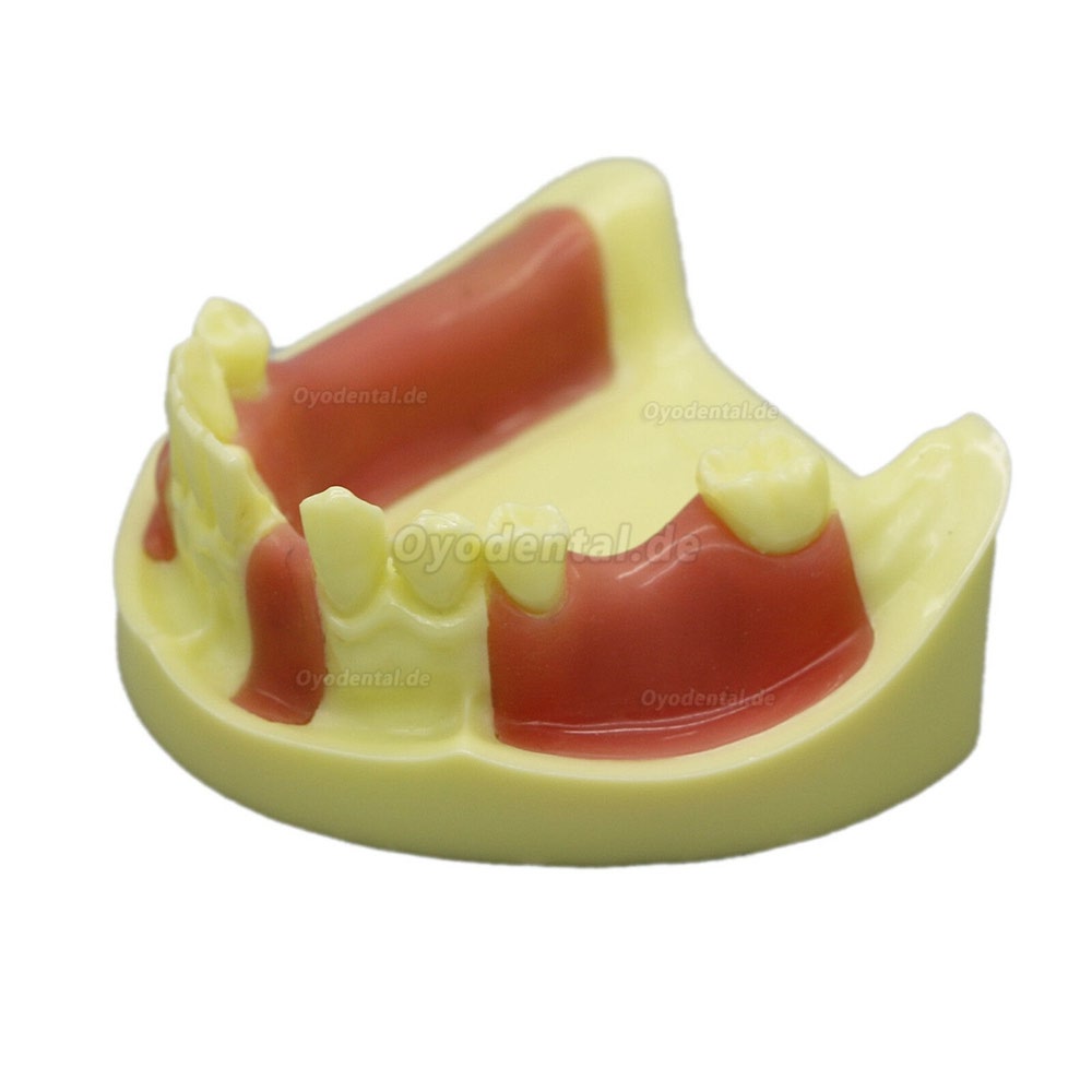 Dental Model # 2004 01 - Unterkieferimplantat-Übungsmodell mit Gingiva