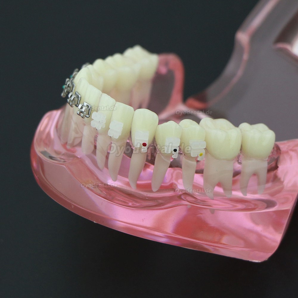 Zahnkieferorthopädisches Zahnmodell Metall- und Keramikbracket Brackets Study Model 3003