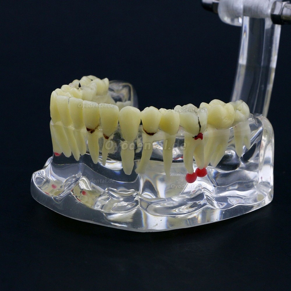 Neue Dental Teach-Studie Allgemeine Erwachsenenpathologie Typodont Zähne Modell # 4001