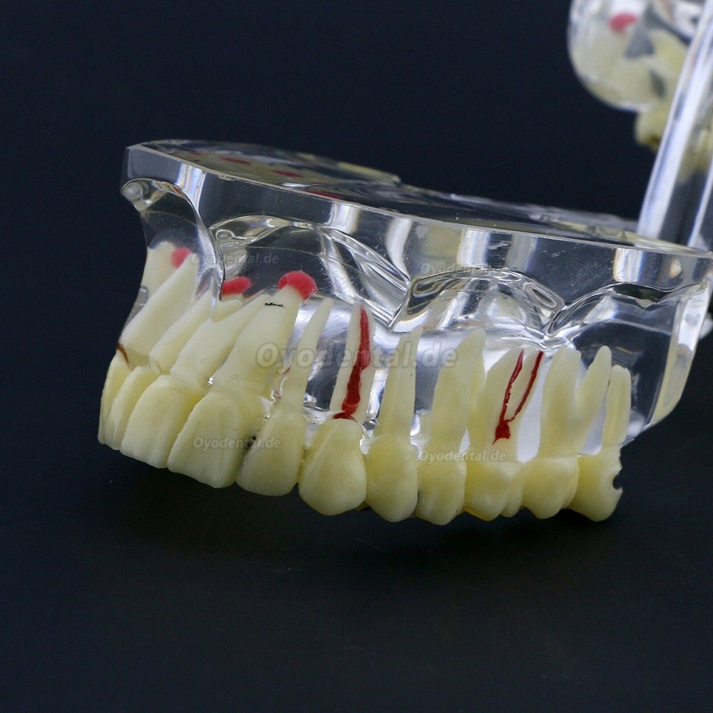 Neue Dental Teach-Studie Allgemeine Erwachsenenpathologie Typodont Zähne Modell # 4001